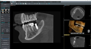 12x85 implant