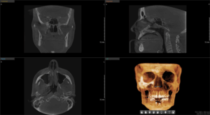 ct1